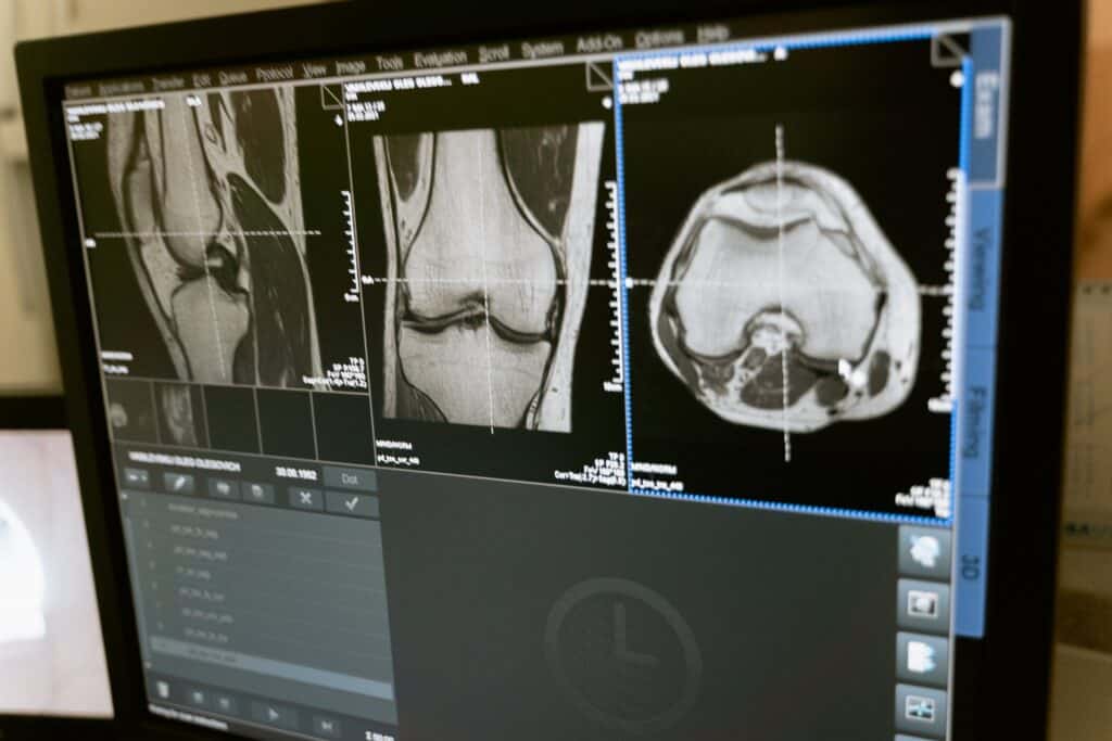 an MRI test of a knee. Did I Tear My ACL?