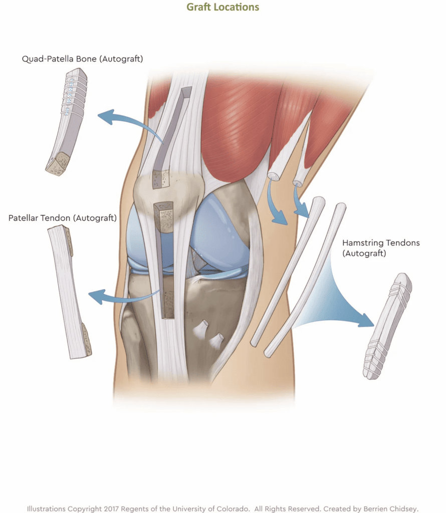 ACL Reconstruction Surgery