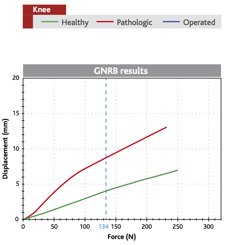 Compliance Curves